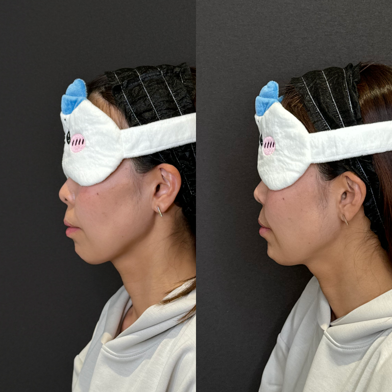 ほうれい線ヒアルロン酸が上手い安いおすすめ人気