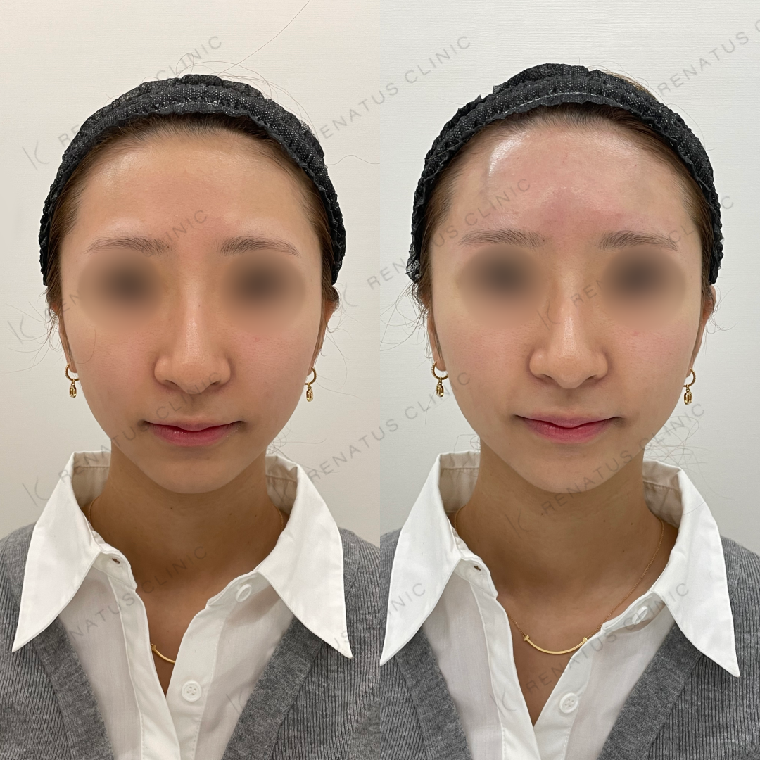 額ヒアルロン酸ボリューマ症例写真
