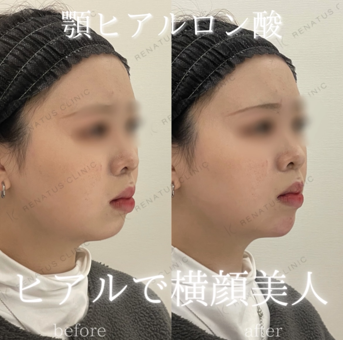 顎ボラックスヒアルロン酸