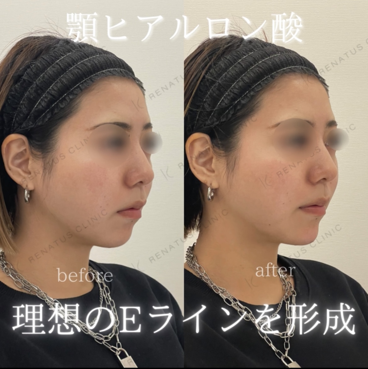 顎ヒアルロン酸ボラックス症例写真 顎ヒアルロン酸ボラックス症例写真