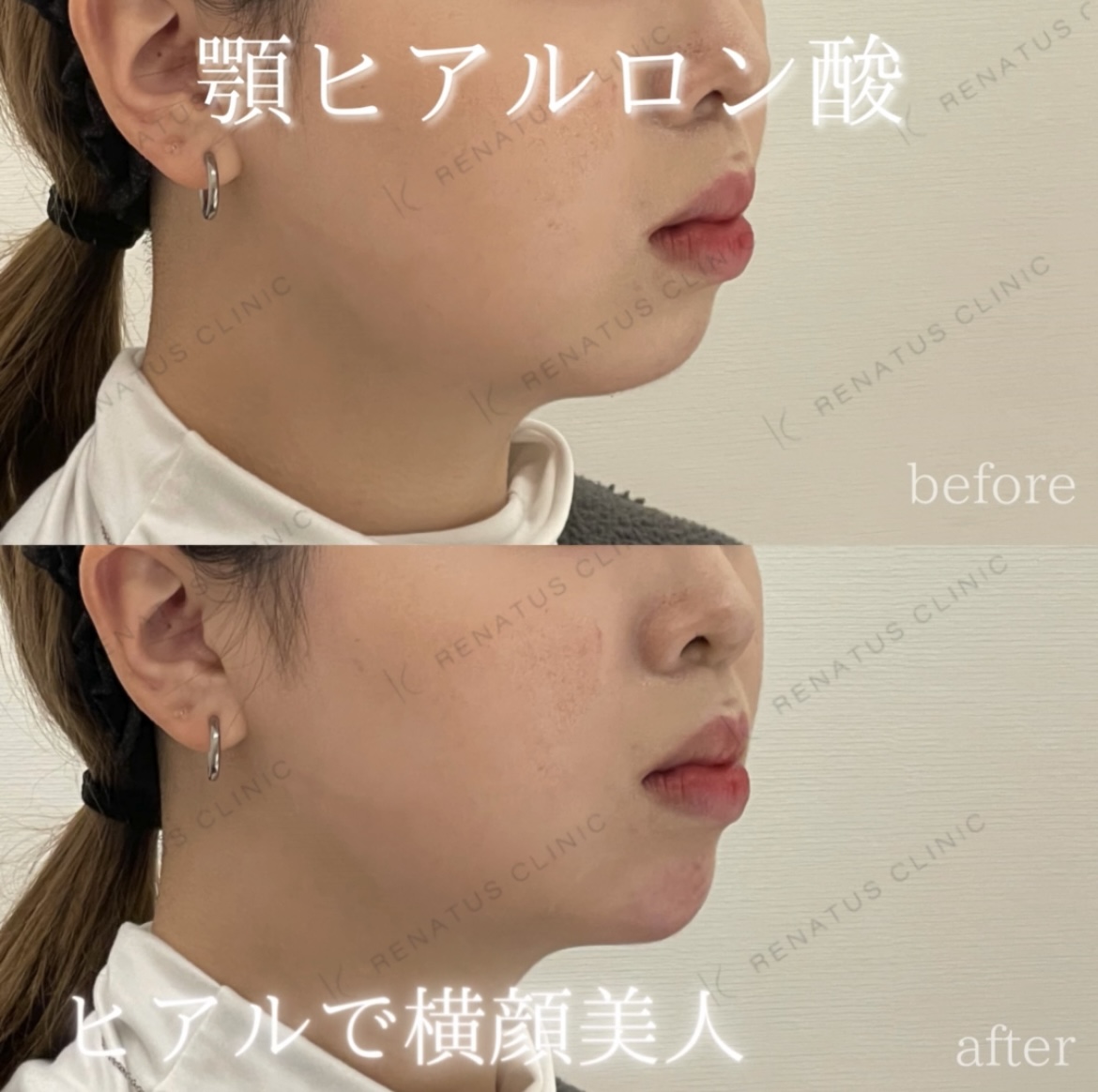 顎ボラックスヒアルロン酸