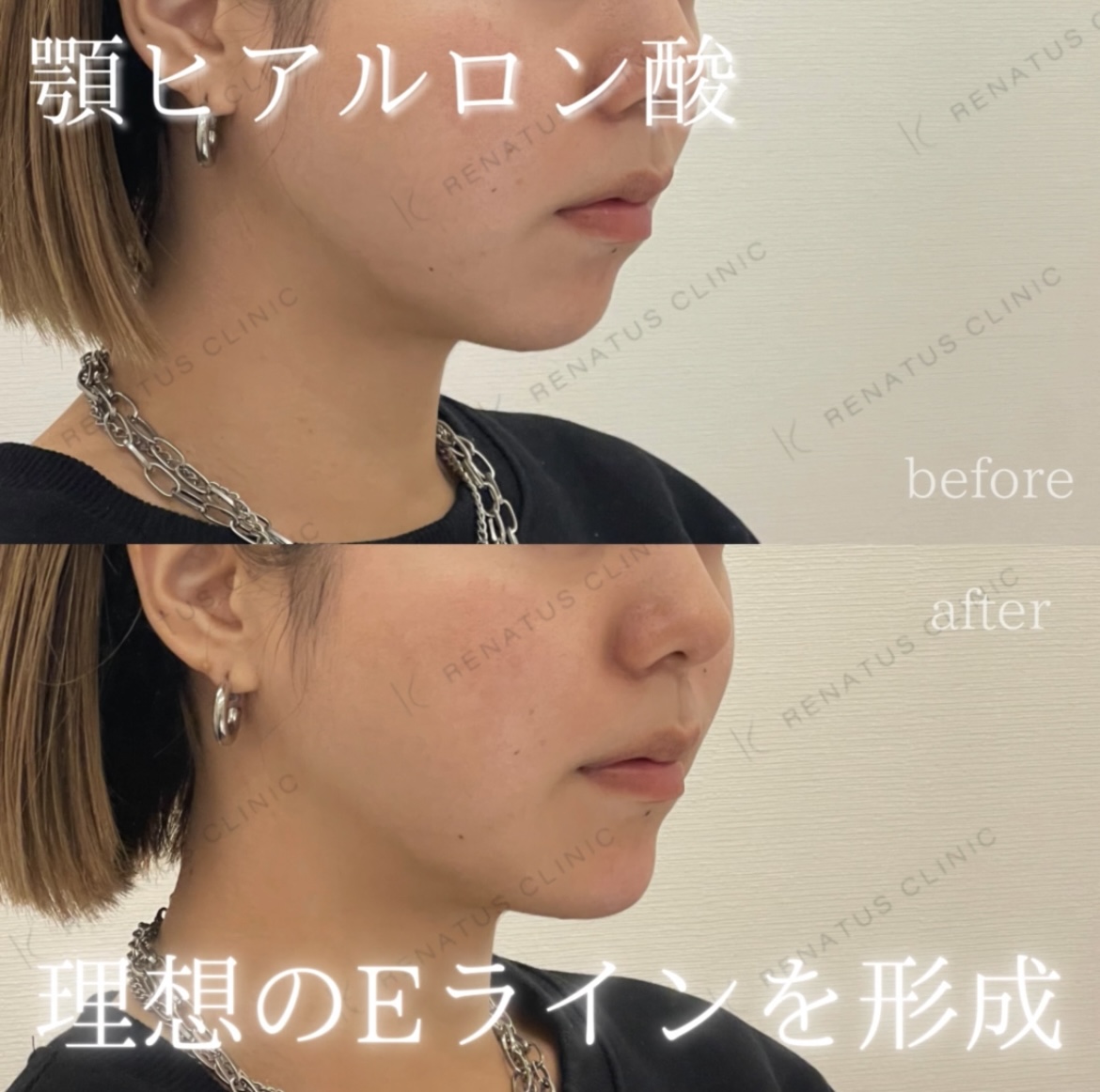 顎ヒアルロン酸ボラックス症例写真 顎ヒアルロン酸ボラックス症例写真