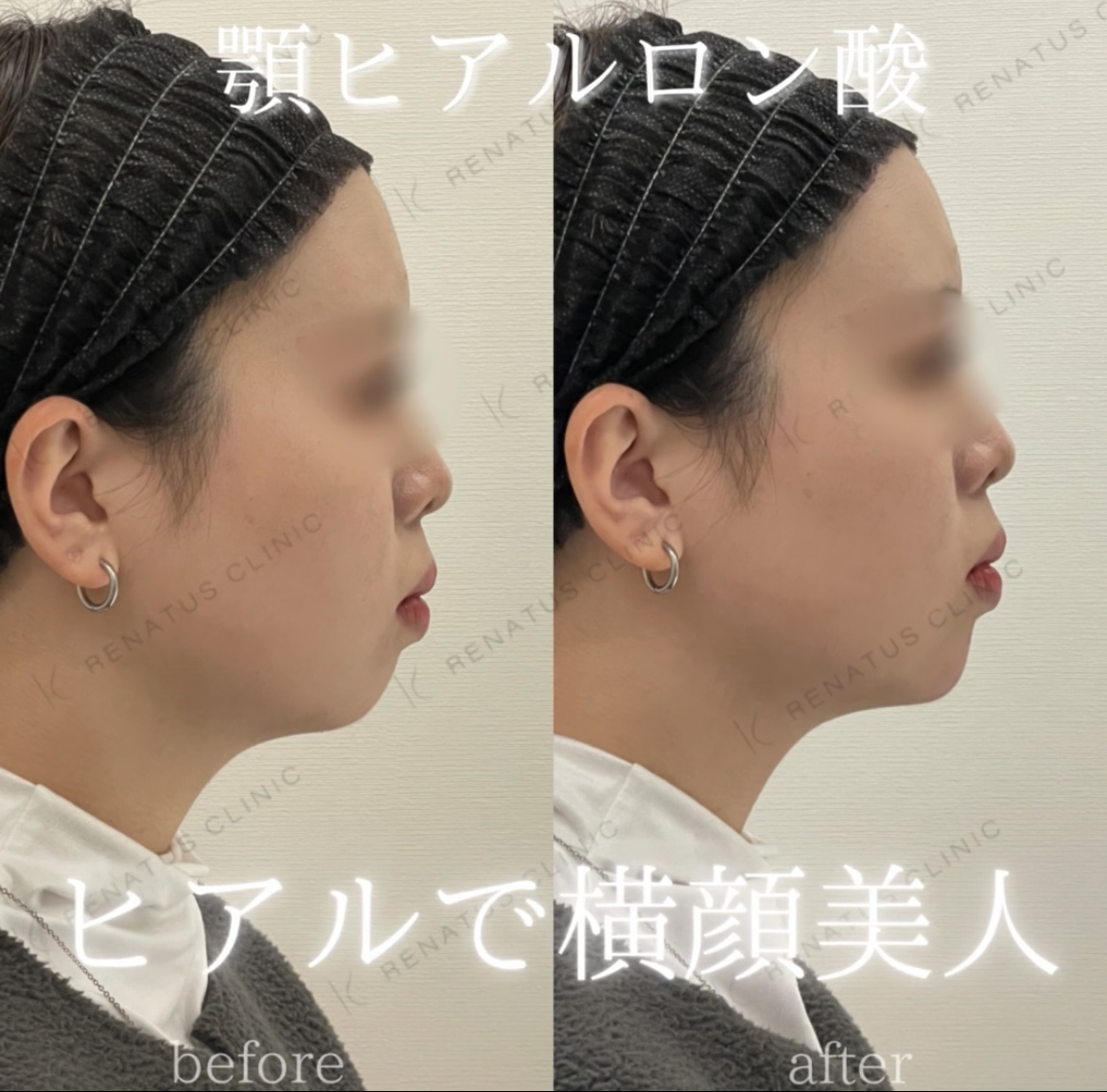 顎ボラックスヒアルロン酸