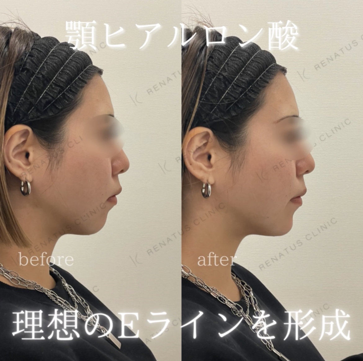 顎ヒアルロン酸ボラックス症例写真 顎ヒアルロン酸ボラックス症例写真