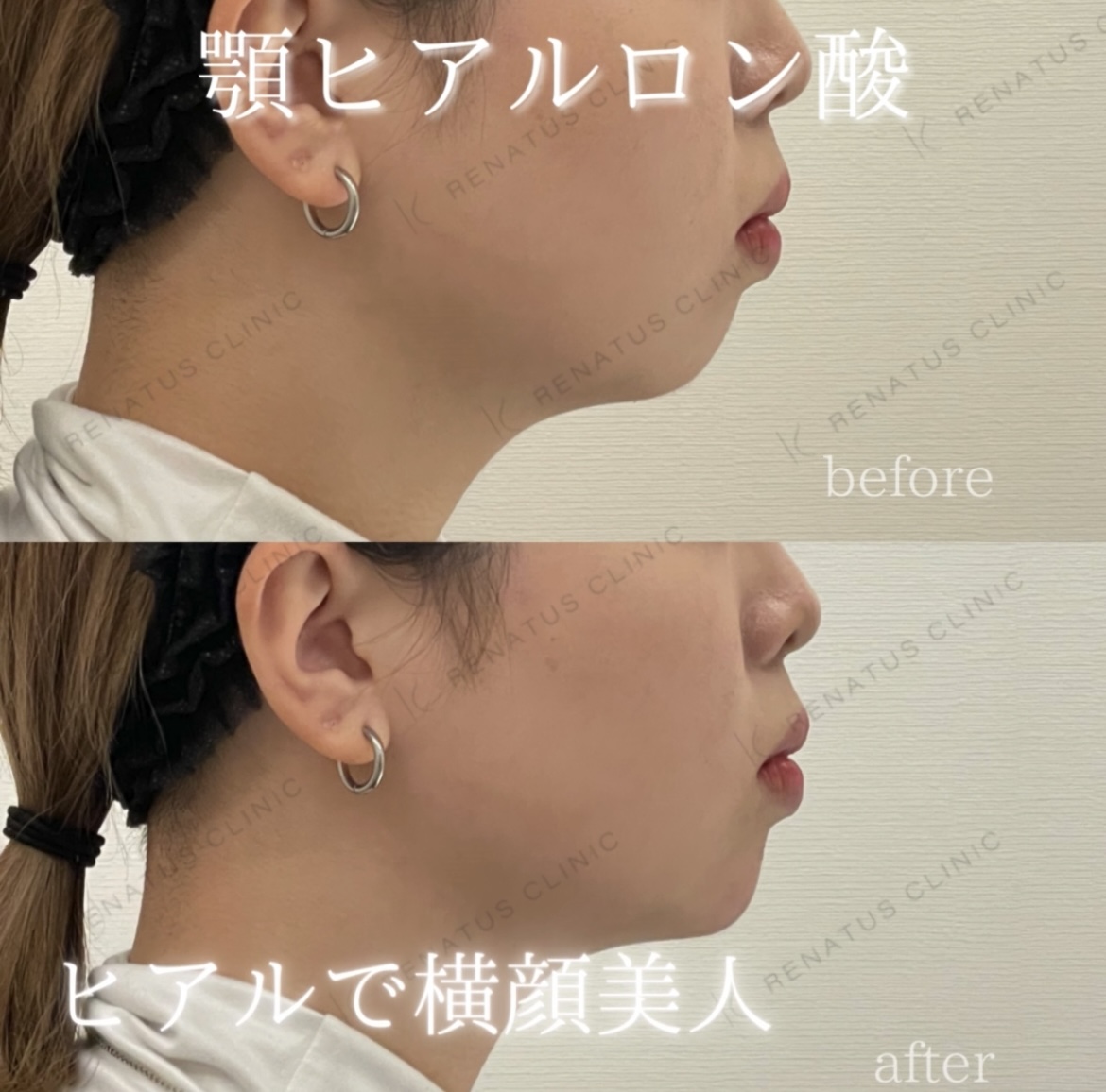 顎ボラックスヒアルロン酸