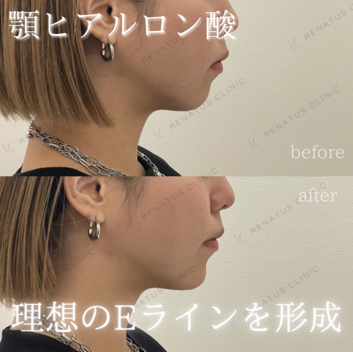 顎ヒアルロン酸ボラックス症例写真 顎ヒアルロン酸ボラックス症例写真