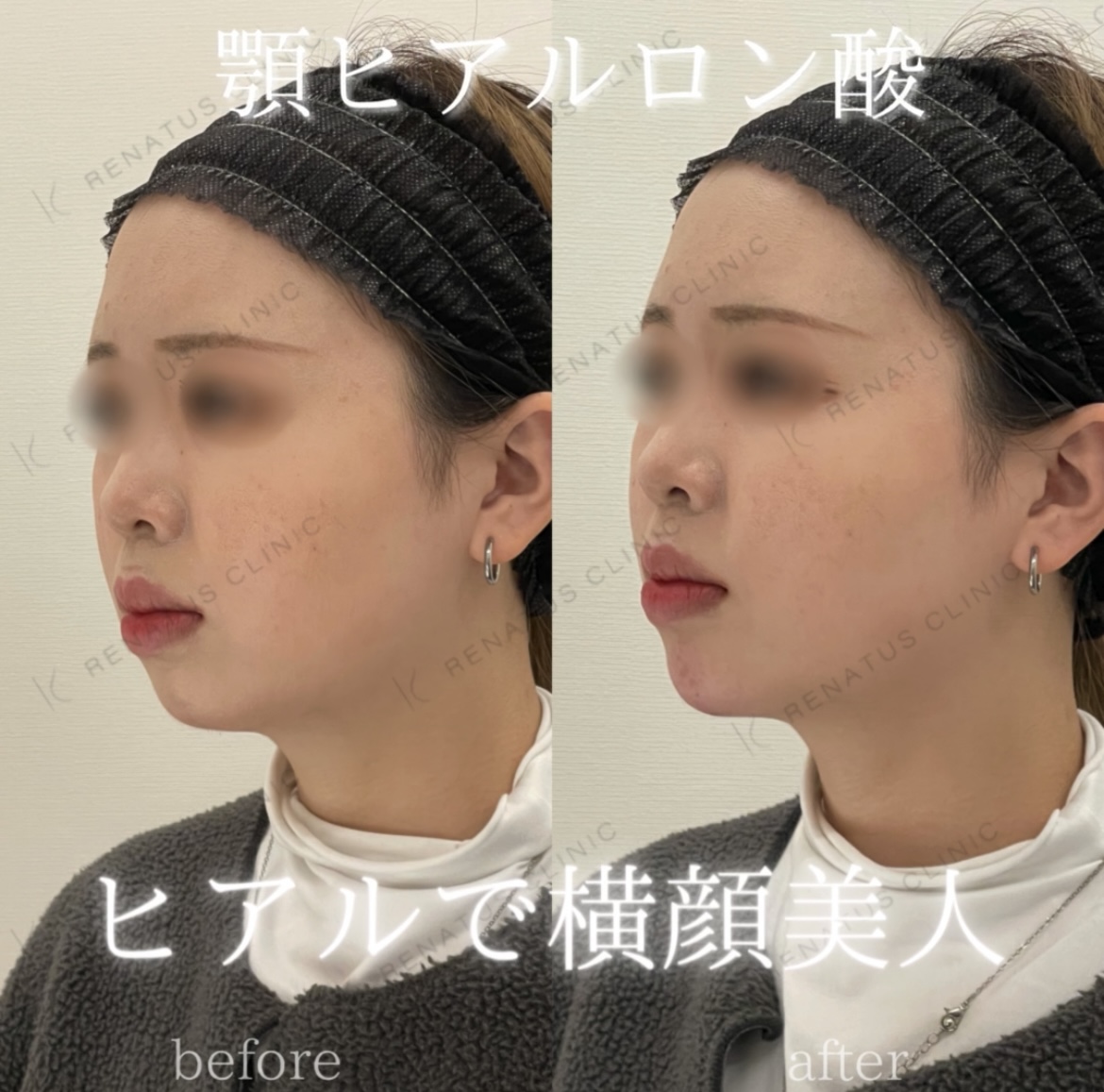 顎ボラックスヒアルロン酸