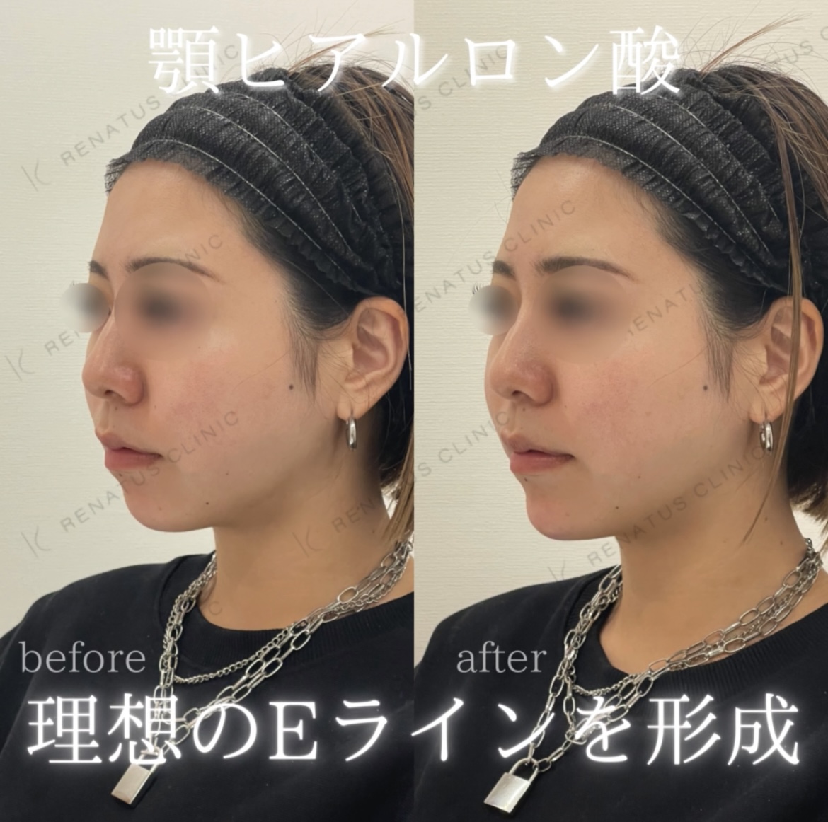 顎ヒアルロン酸ボラックス症例写真 顎ヒアルロン酸ボラックス症例写真