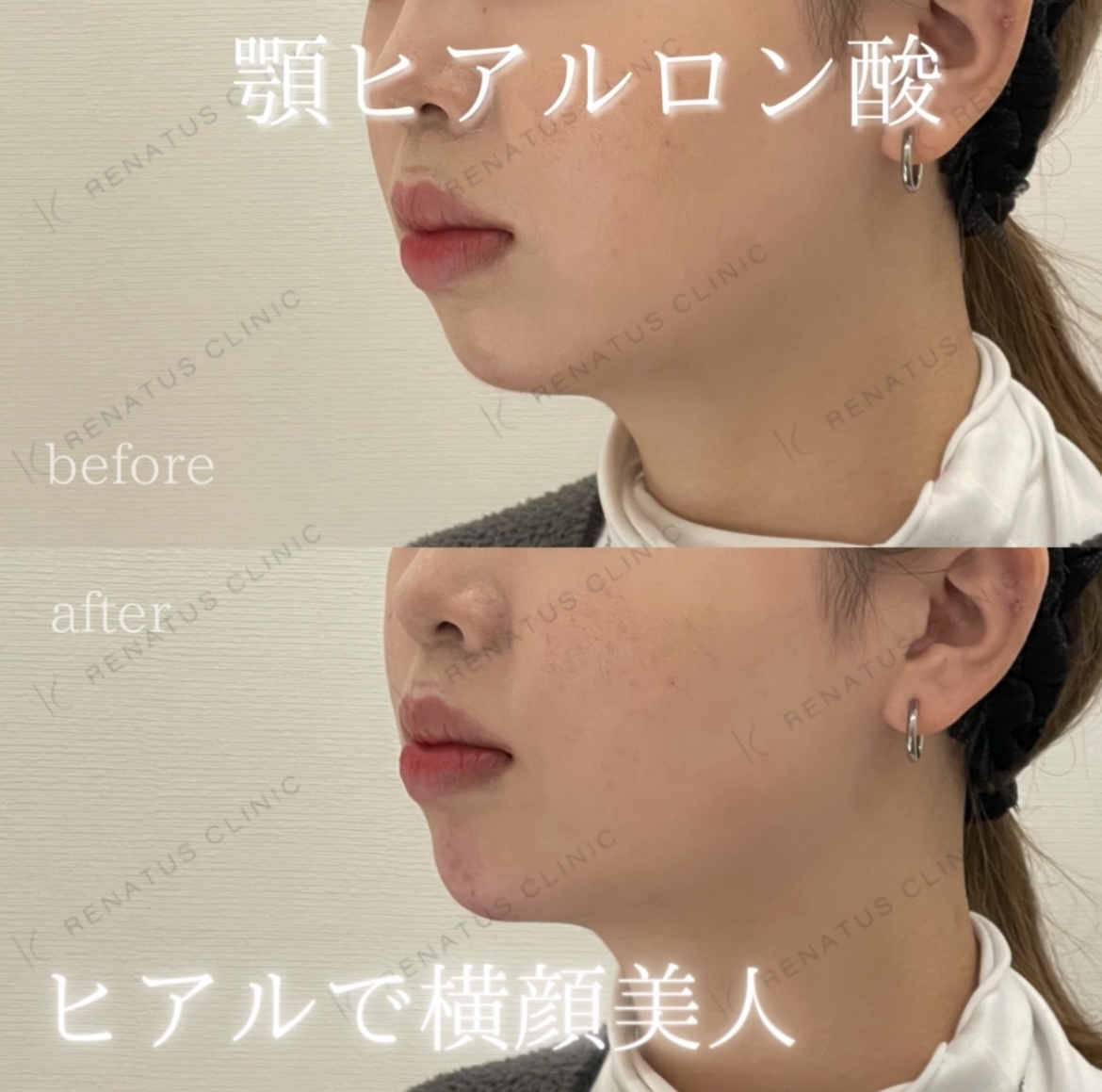 顎ボラックスヒアルロン酸