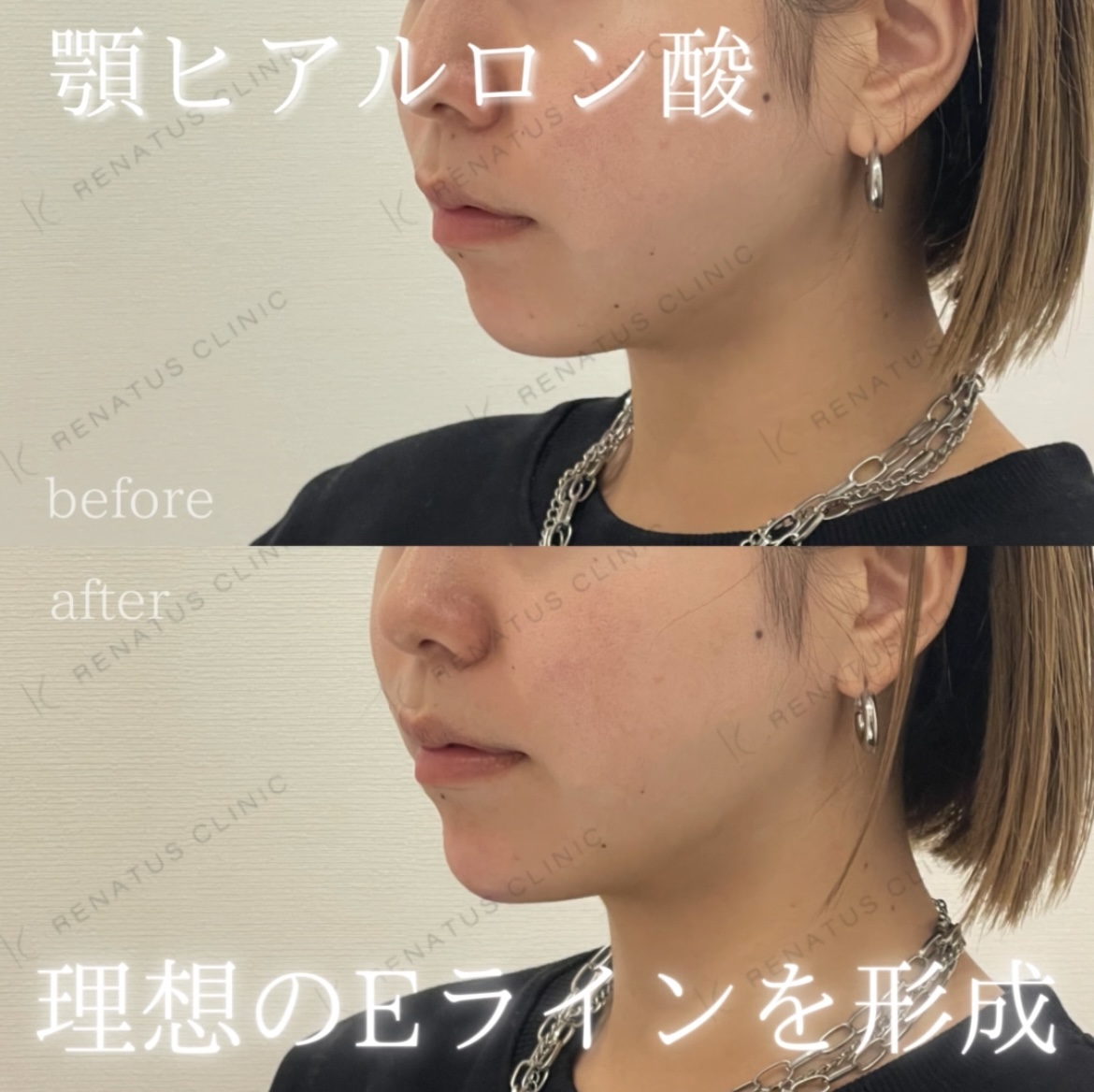 顎ヒアルロン酸ボラックス症例写真 顎ヒアルロン酸ボラックス症例写真