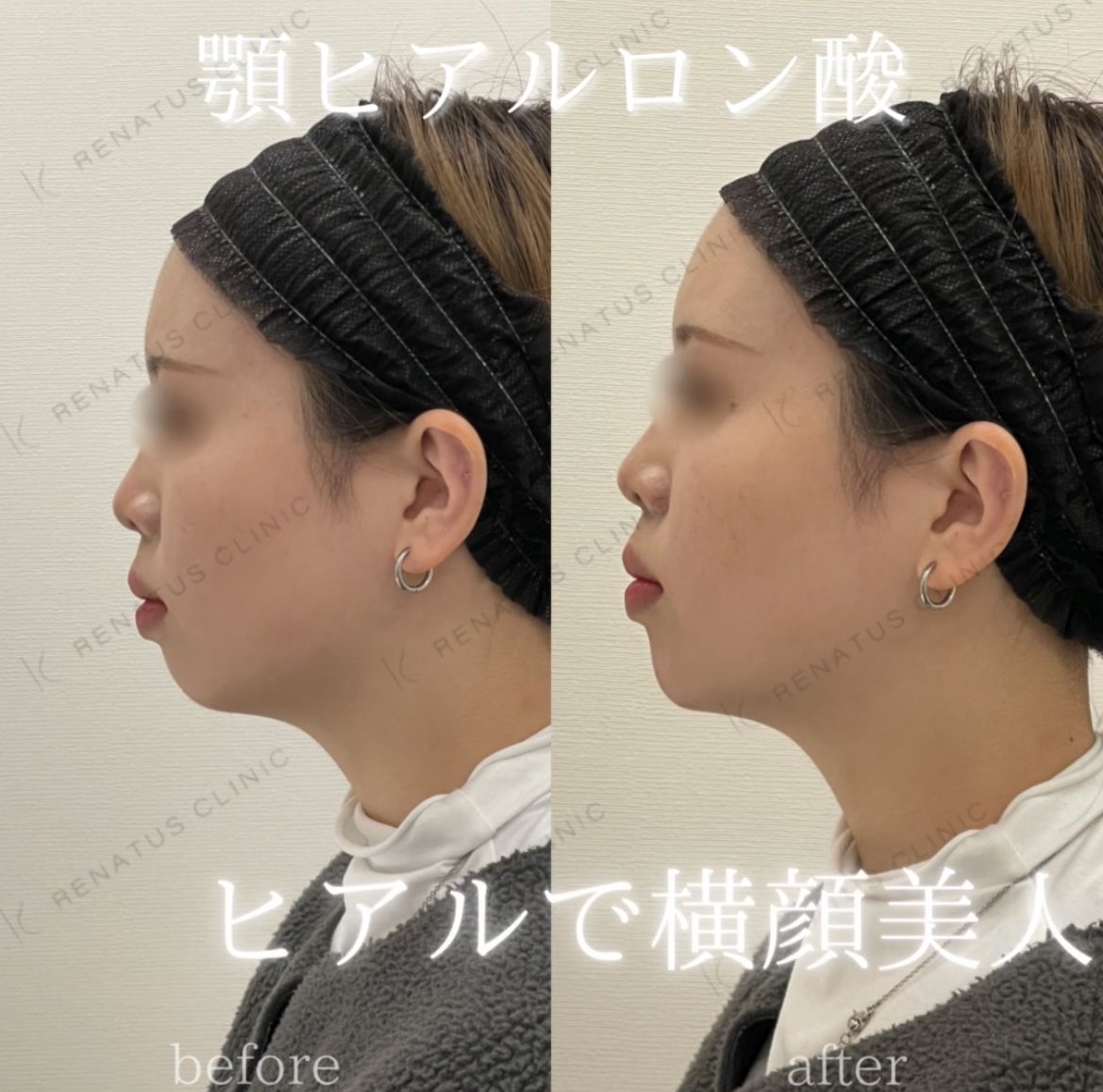 顎ボラックスヒアルロン酸