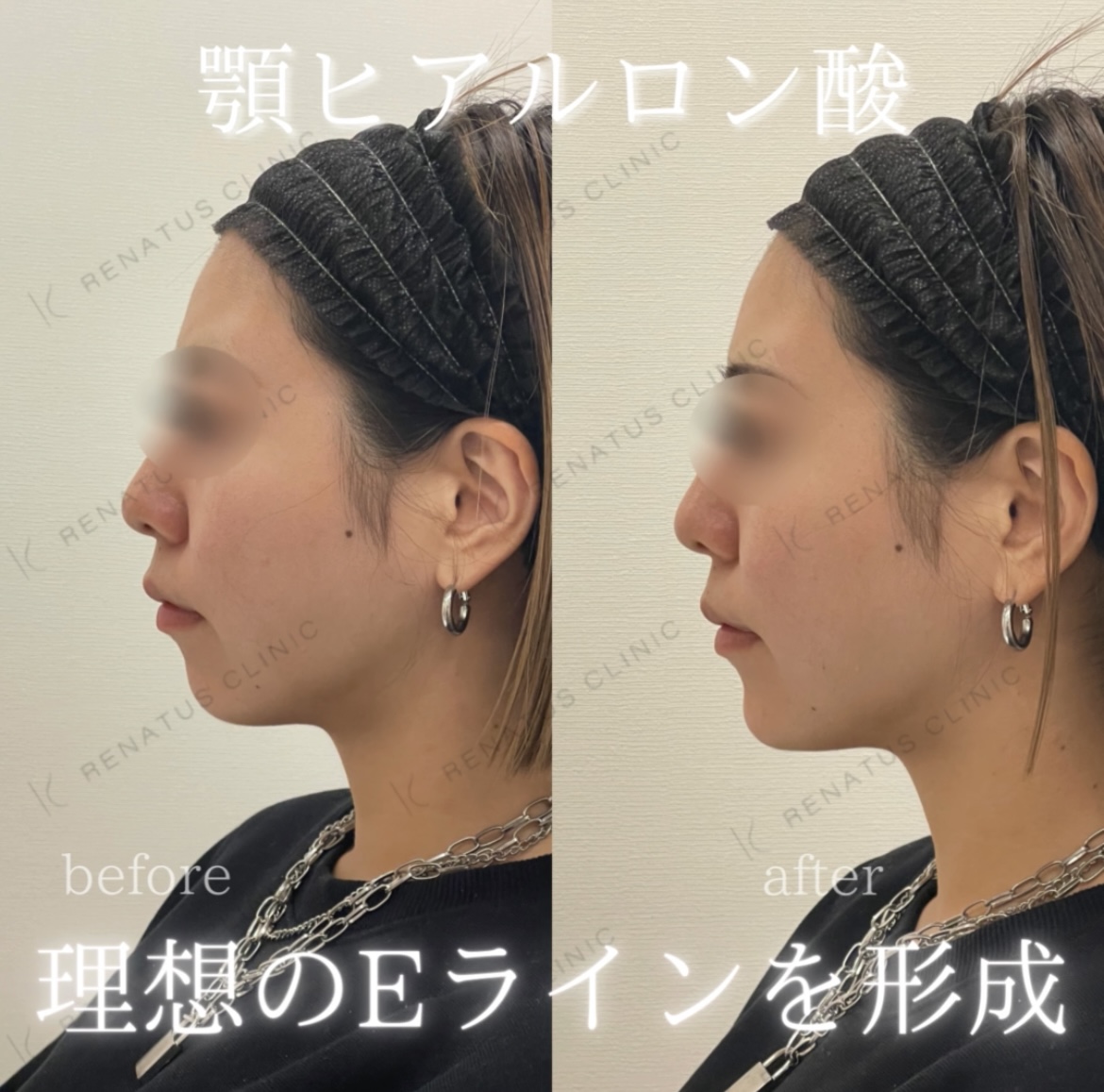 顎ヒアルロン酸ボラックス症例写真 顎ヒアルロン酸ボラックス症例写真