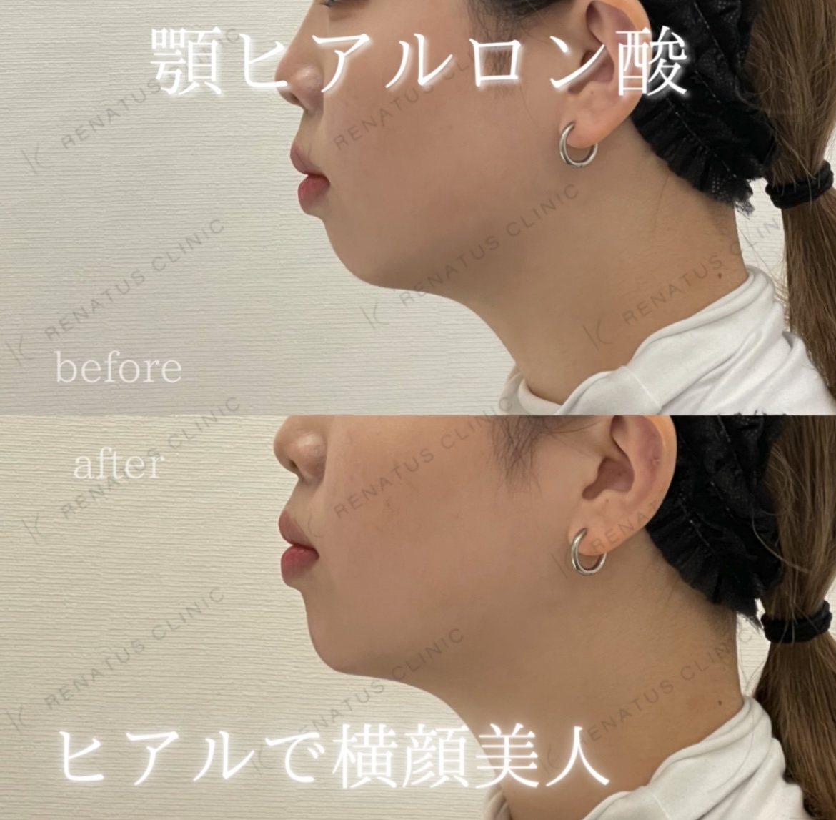 顎ボラックスヒアルロン酸