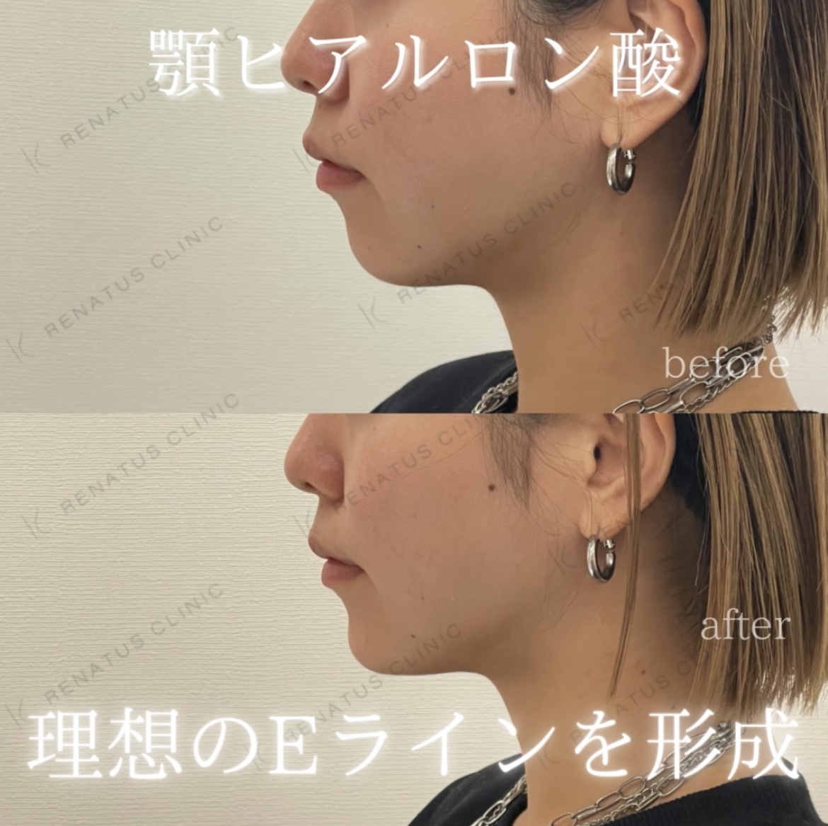 顎ヒアルロン酸ボラックス症例写真 顎ヒアルロン酸ボラックス症例写真