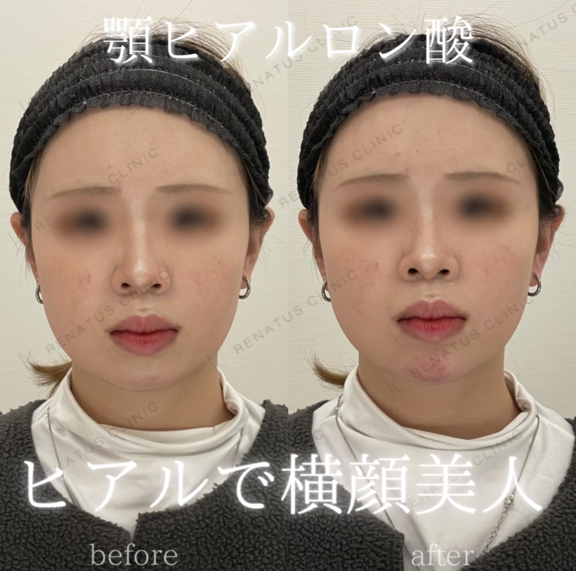 顎ボラックスヒアルロン酸