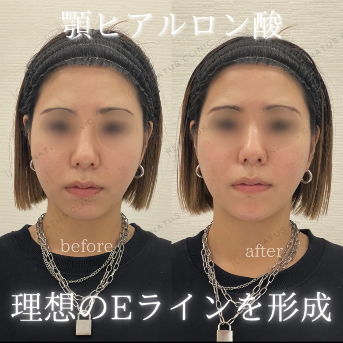 顎ヒアルロン酸ボラックス症例写真 顎ヒアルロン酸ボラックス症例写真