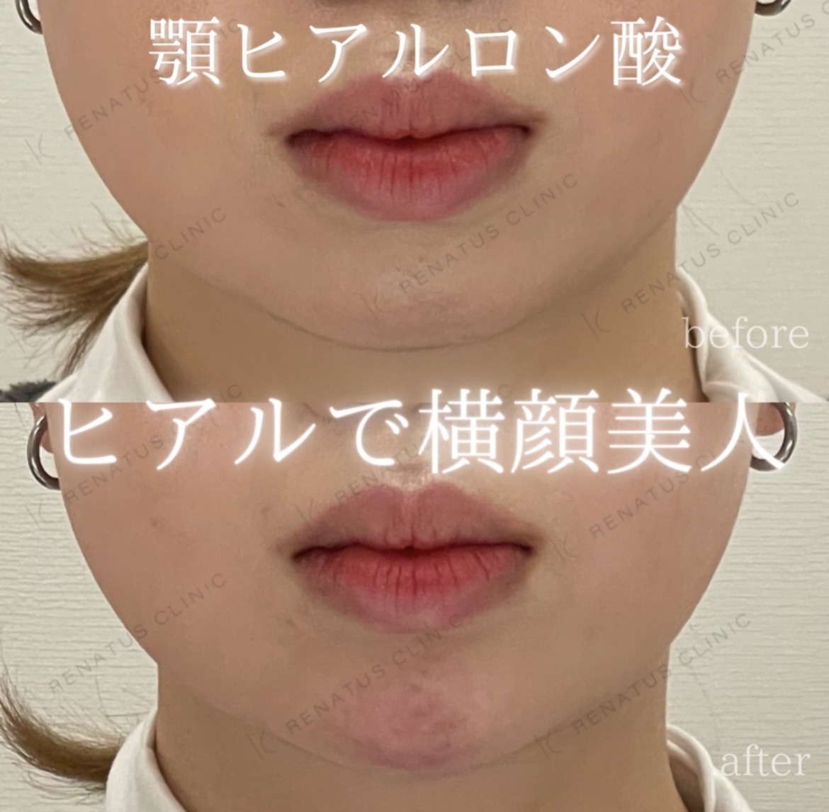 顎ボラックスヒアルロン酸