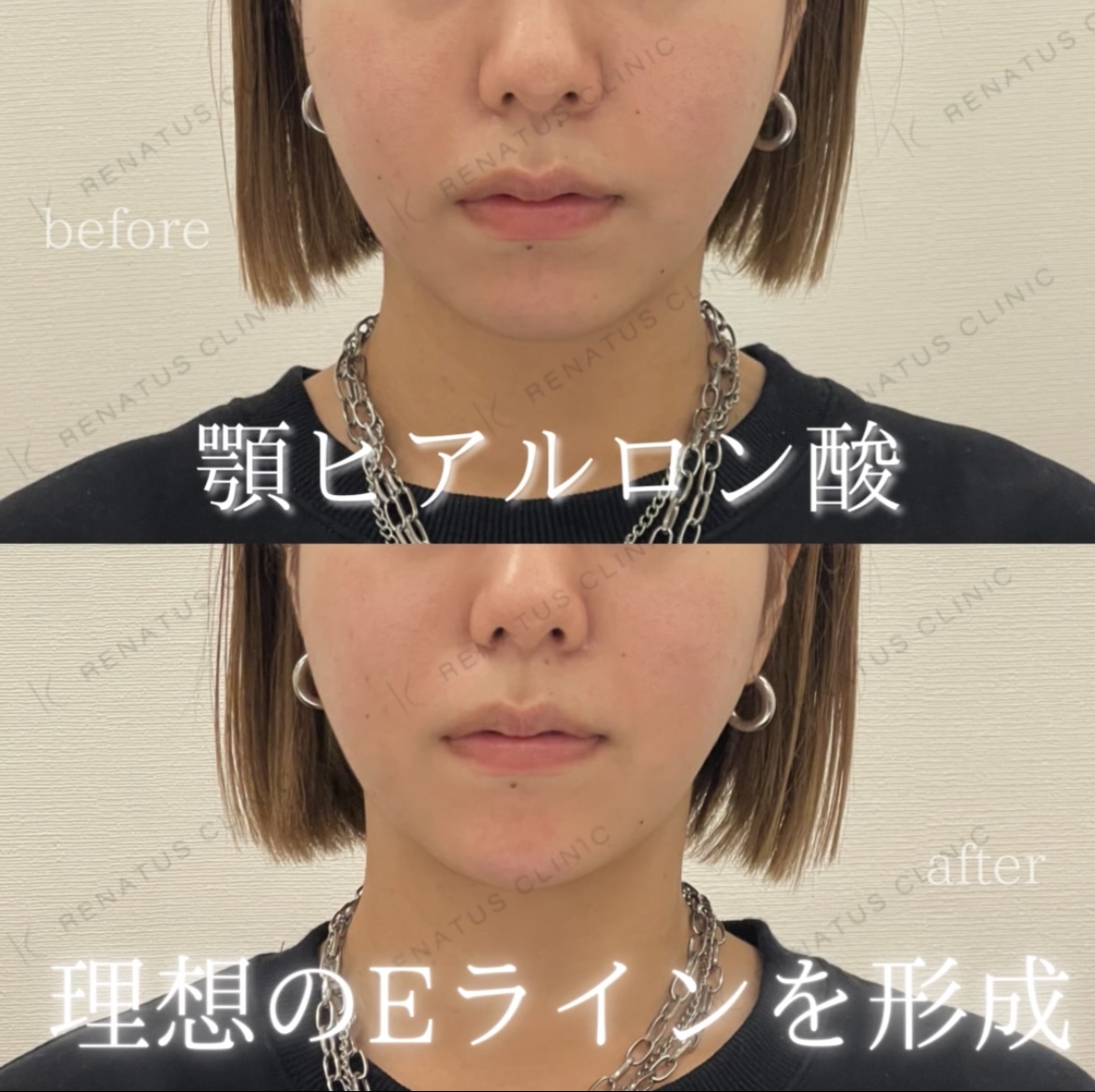 顎ヒアルロン酸ボラックス症例写真 顎ヒアルロン酸ボラックス症例写真