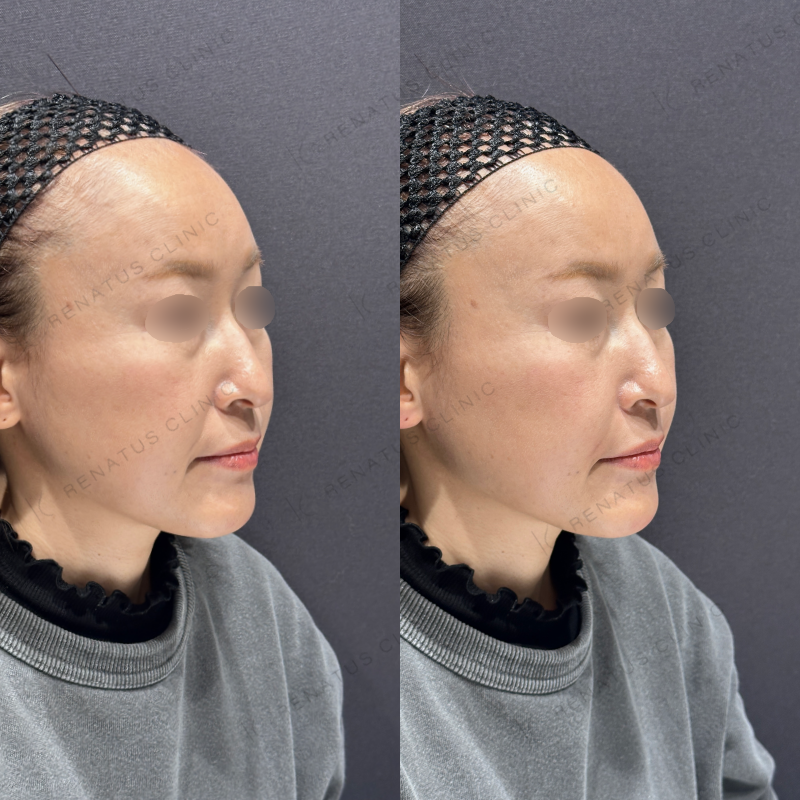 ほうれい線ヒアルロン酸ボリフト症例写真