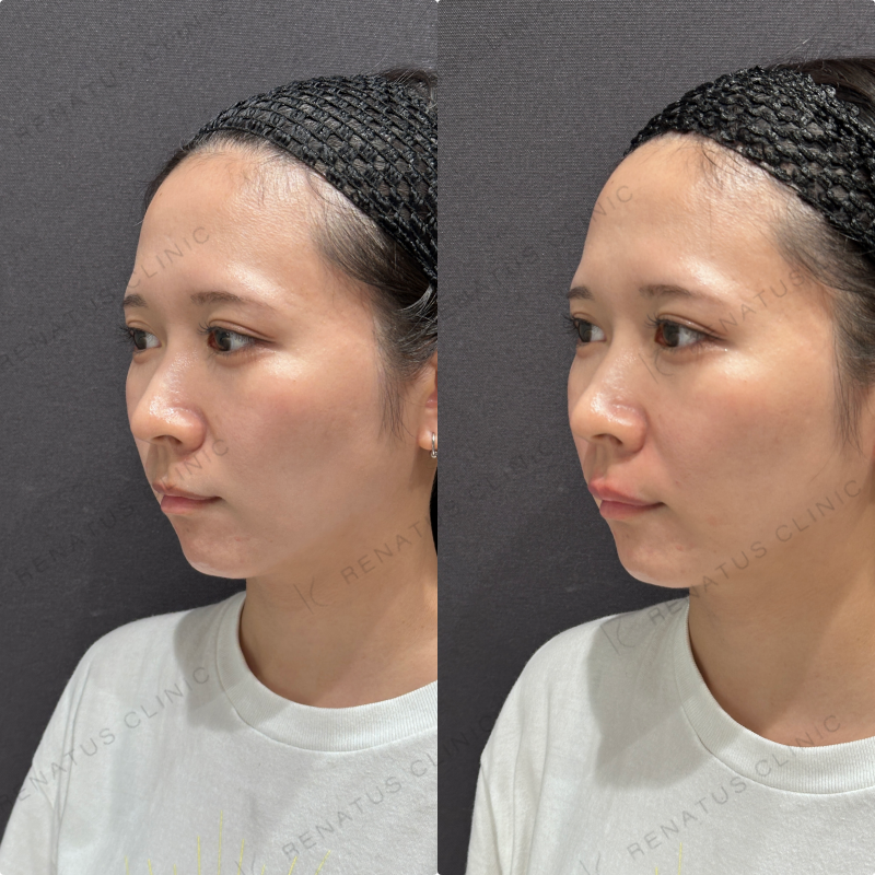 ほうれい線ヒアルロン酸ボルベラ症例写真