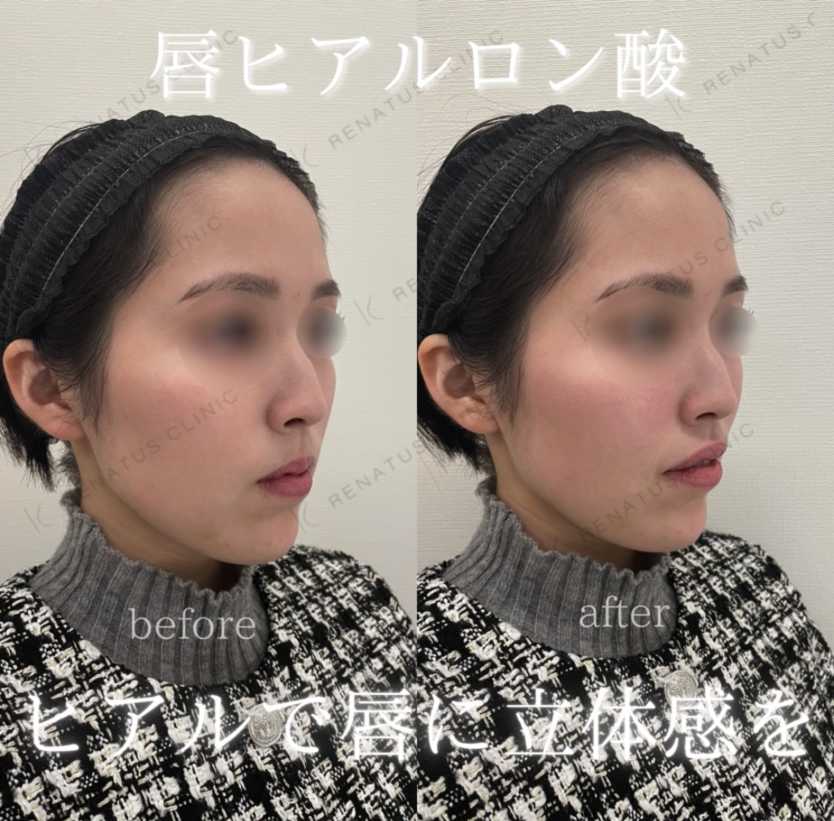 唇ヒアルロン酸ボルベラ症例写真