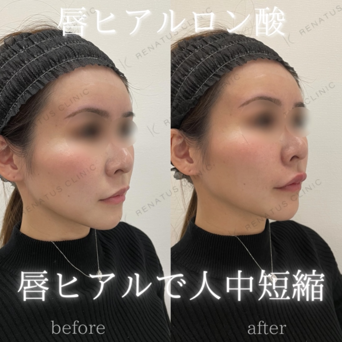唇ボルベラヒアルロン酸