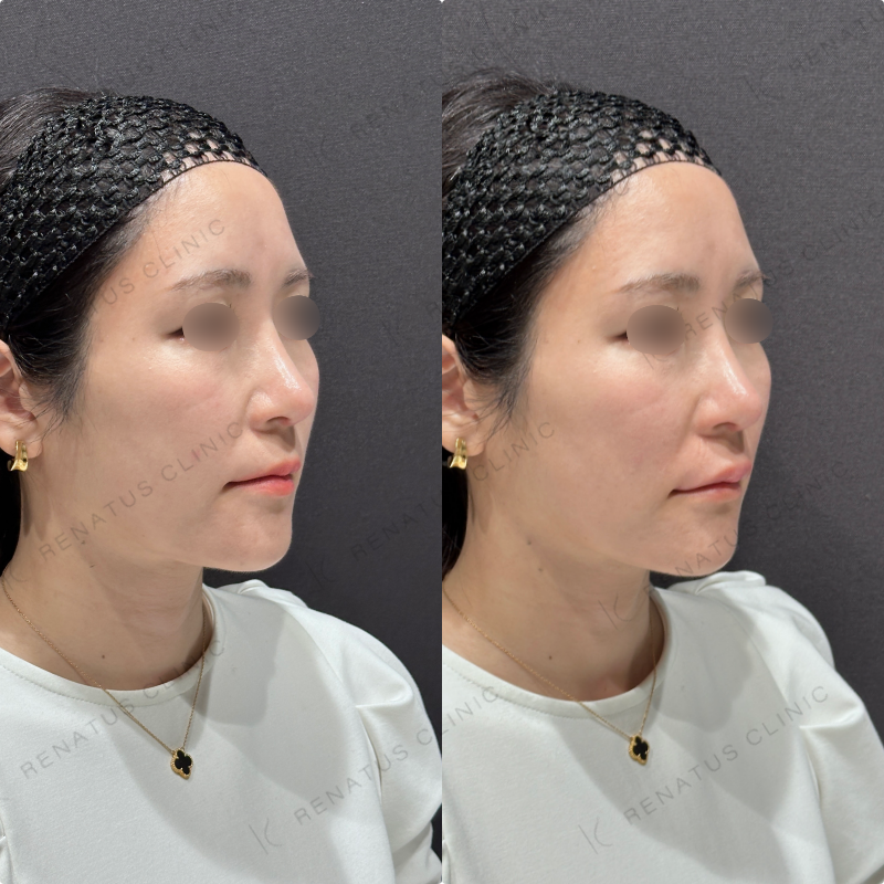 唇ヒアルロン酸ボルベラ症例写真