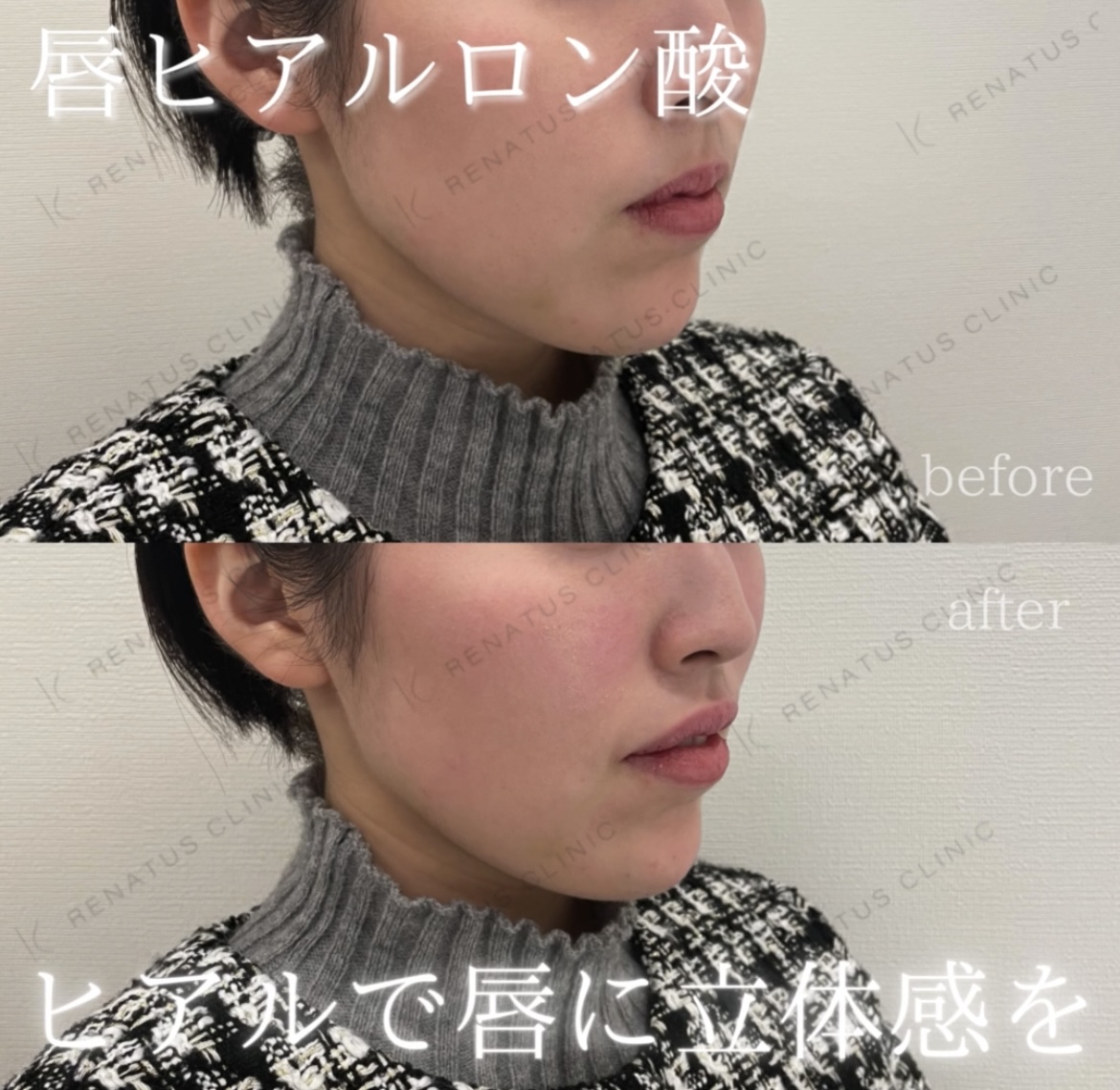 唇ヒアルロン酸ボルベラ症例写真