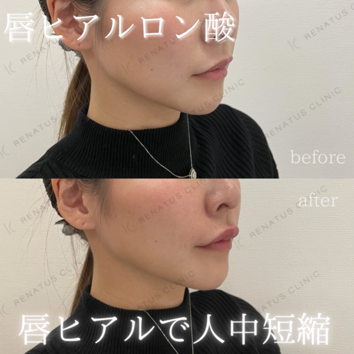 唇ボルベラヒアルロン酸