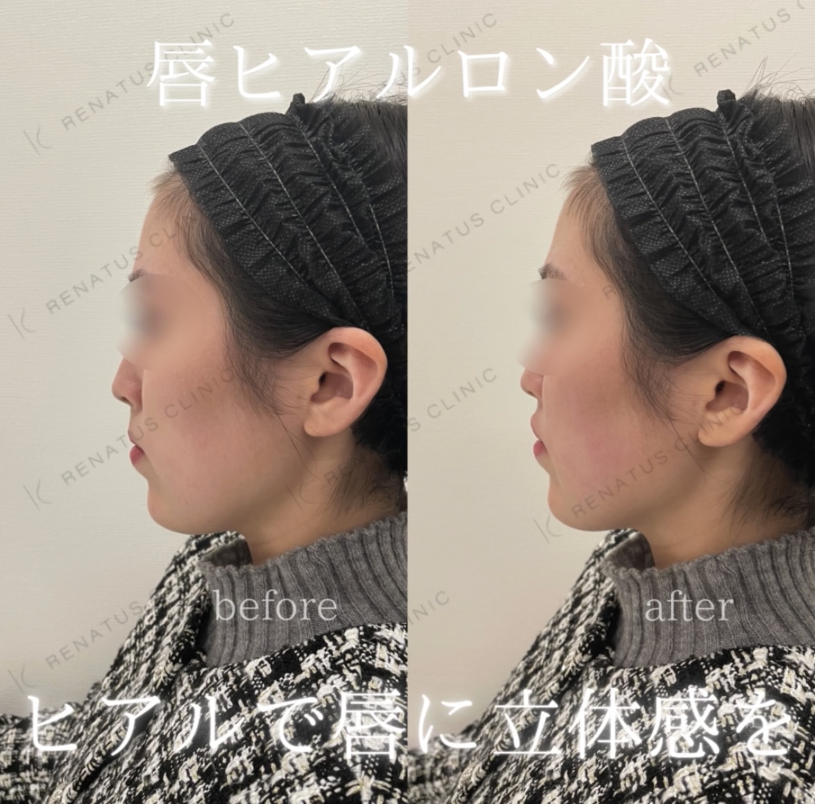 唇ヒアルロン酸ボルベラ症例写真