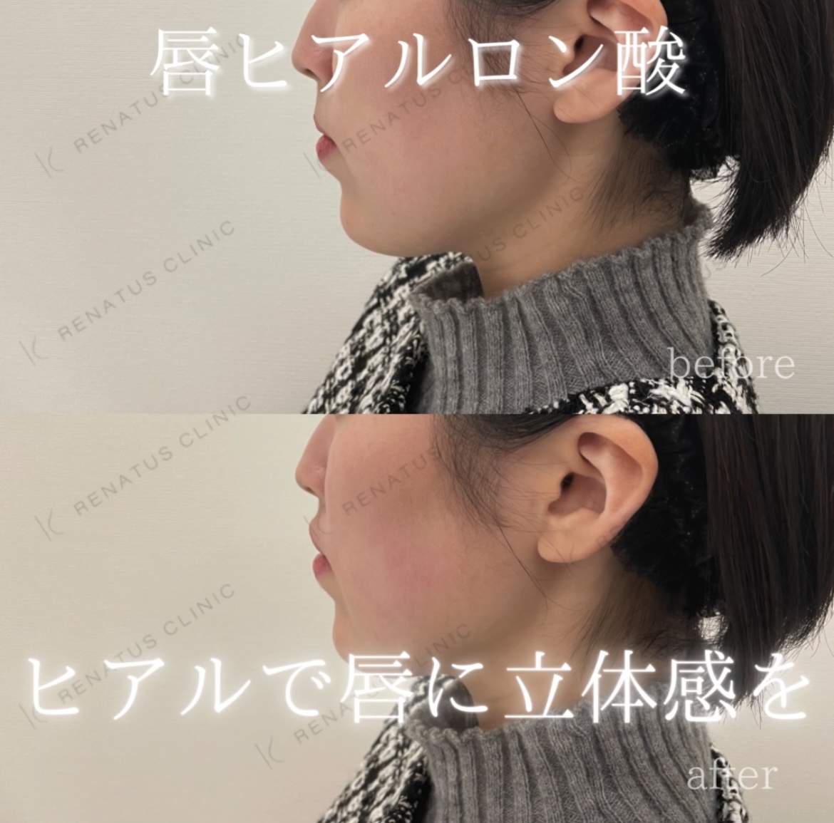 唇ヒアルロン酸ボルベラ症例写真