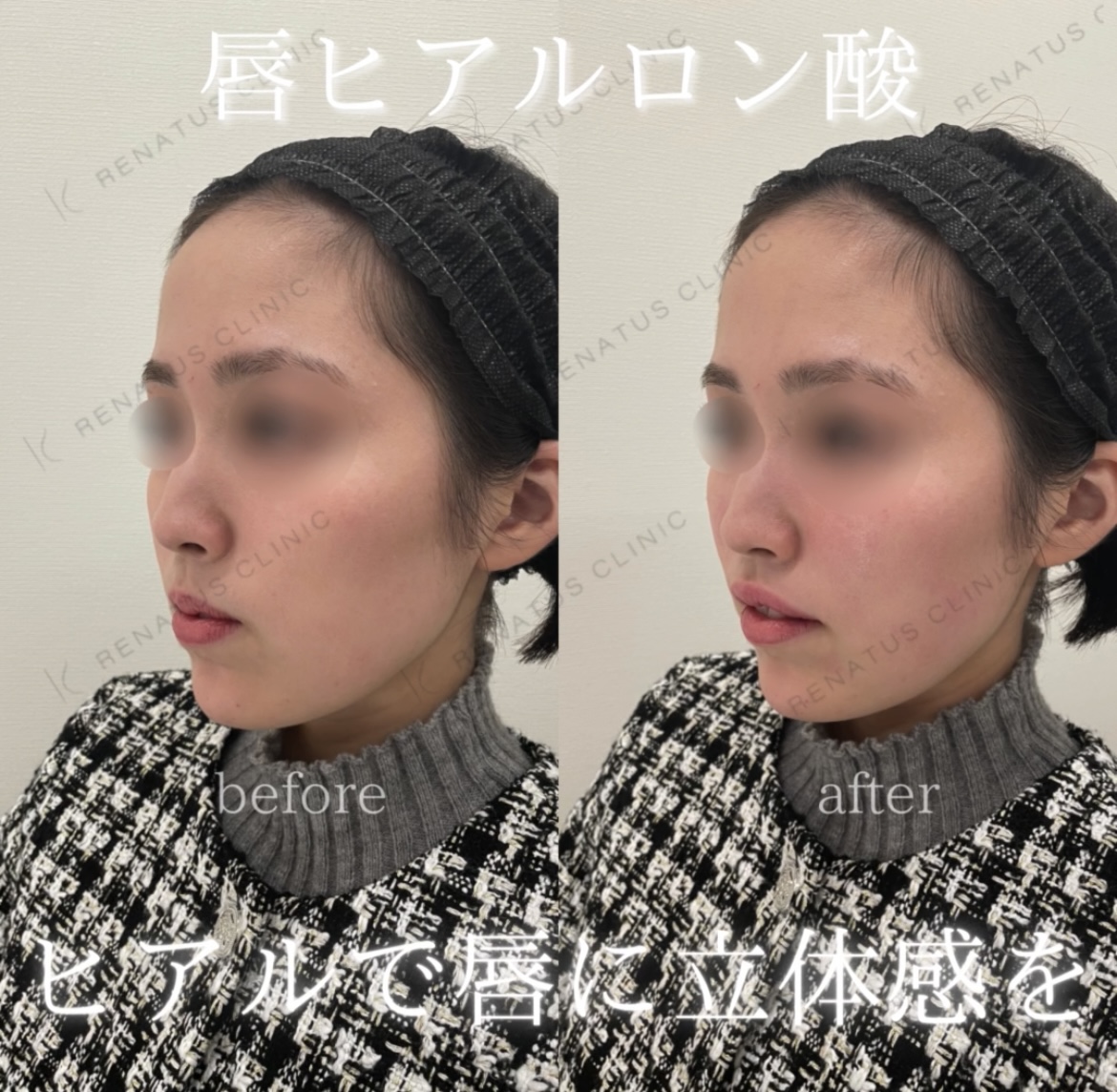 唇ヒアルロン酸ボルベラ症例写真