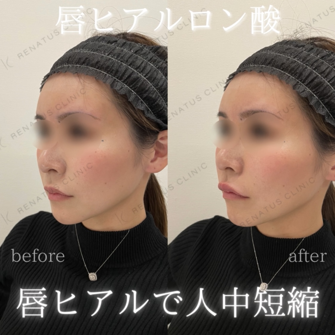 唇ボルベラヒアルロン酸