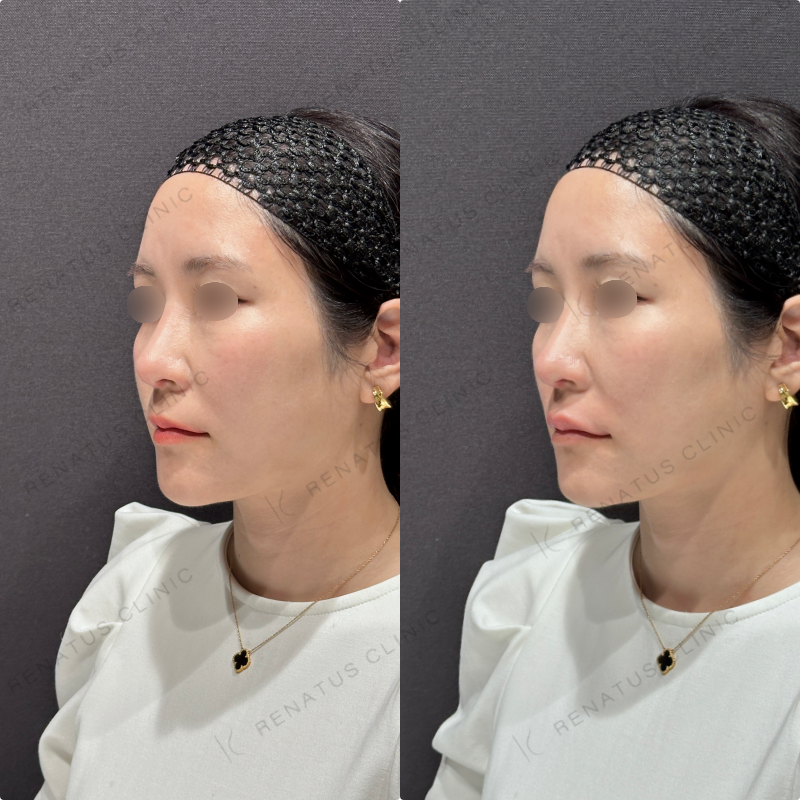 唇ヒアルロン酸ボルベラ症例写真