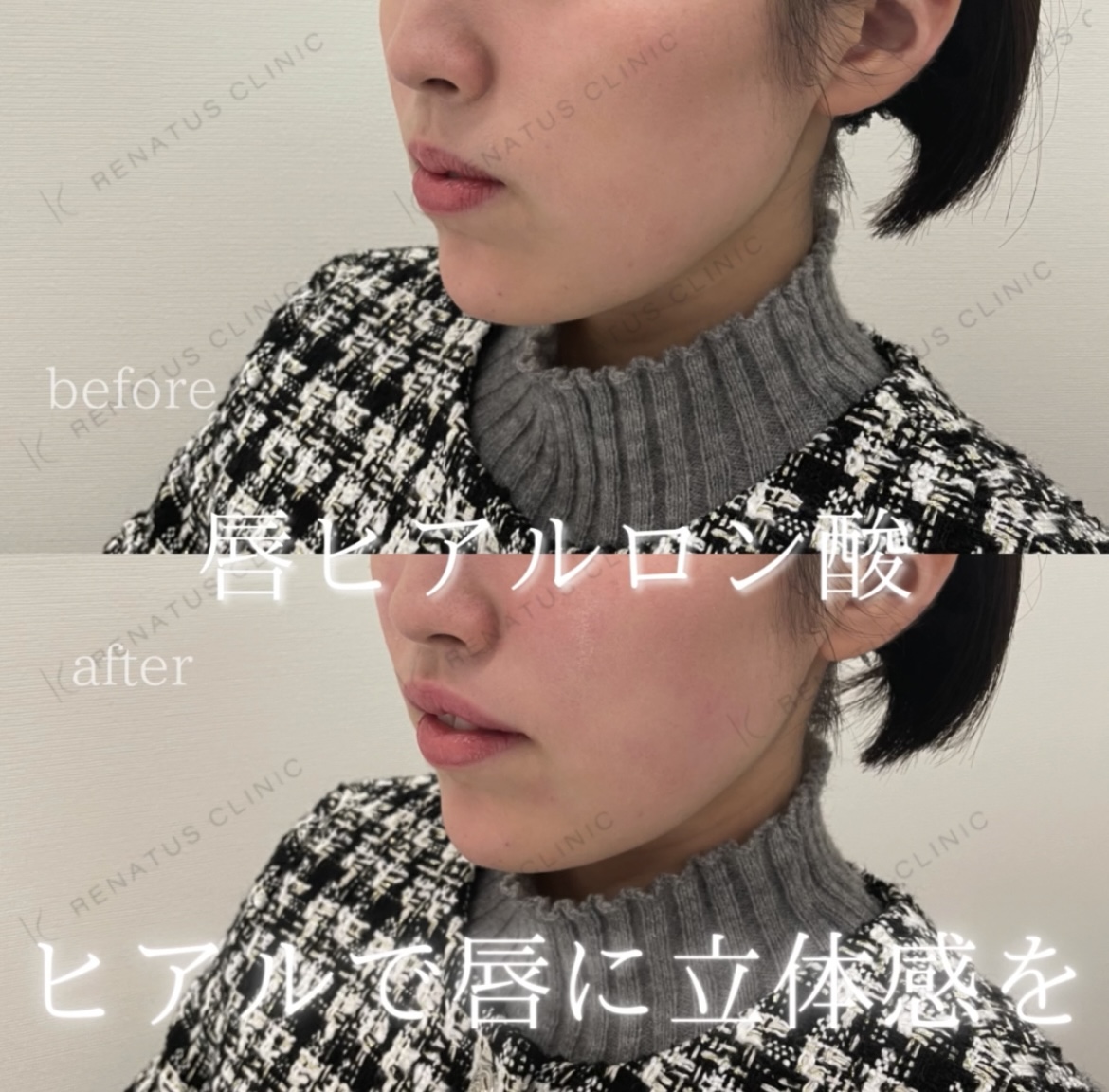 唇ヒアルロン酸ボルベラ症例写真