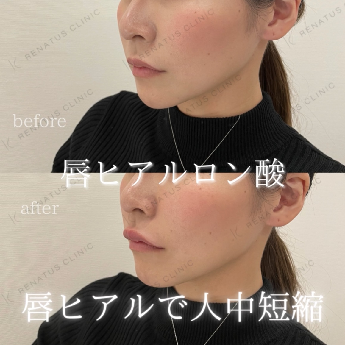 唇ボルベラヒアルロン酸