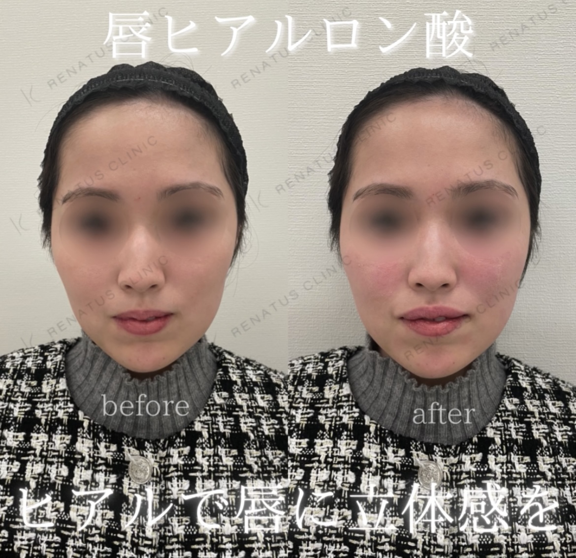 唇ヒアルロン酸ボルベラ症例写真