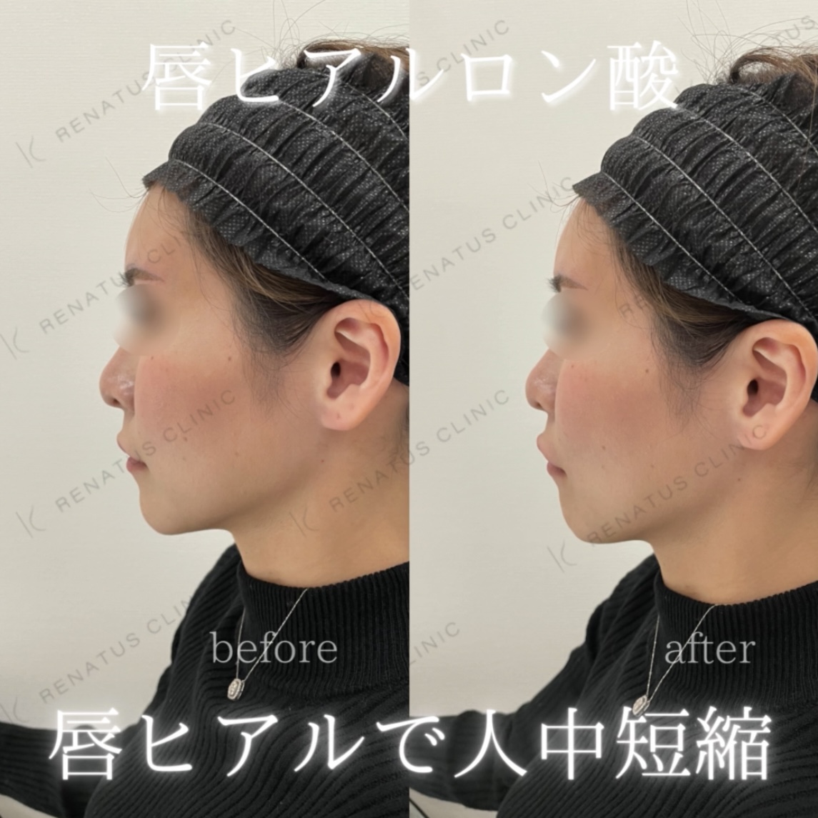 唇ボルベラヒアルロン酸