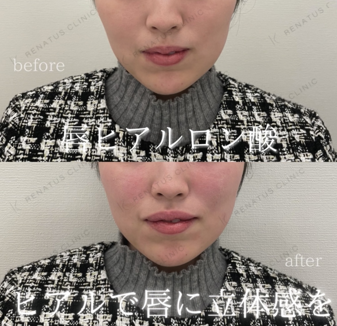 唇ヒアルロン酸ボルベラ症例写真