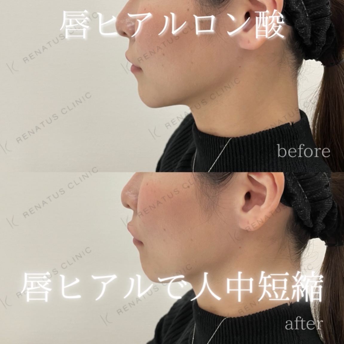 唇ボルベラヒアルロン酸