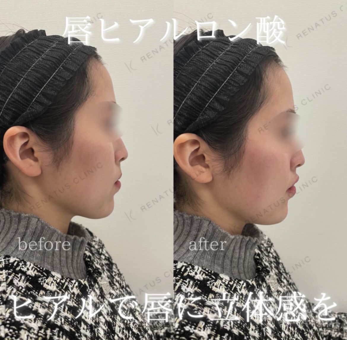 唇ヒアルロン酸ボルベラ症例写真