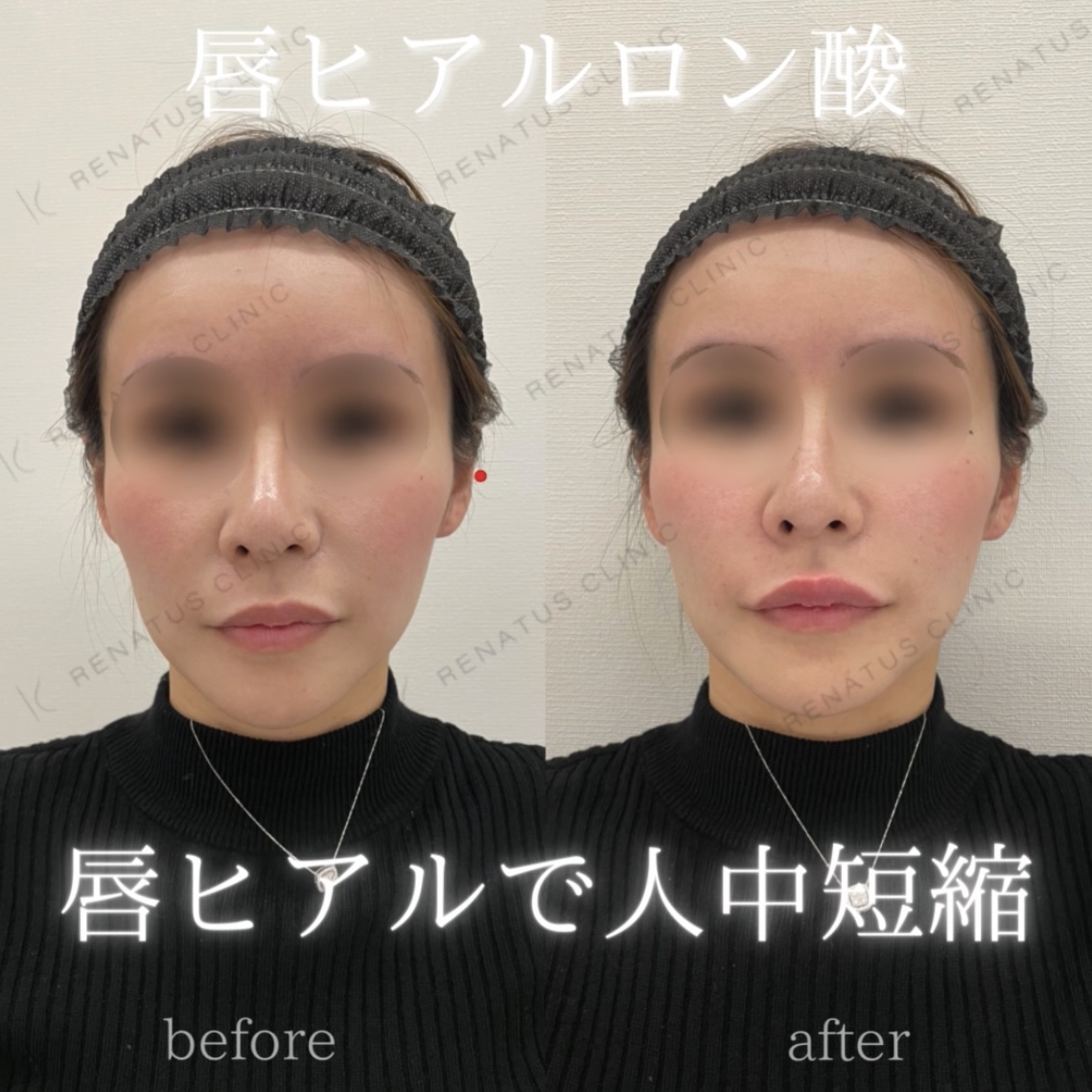 唇ボルベラヒアルロン酸