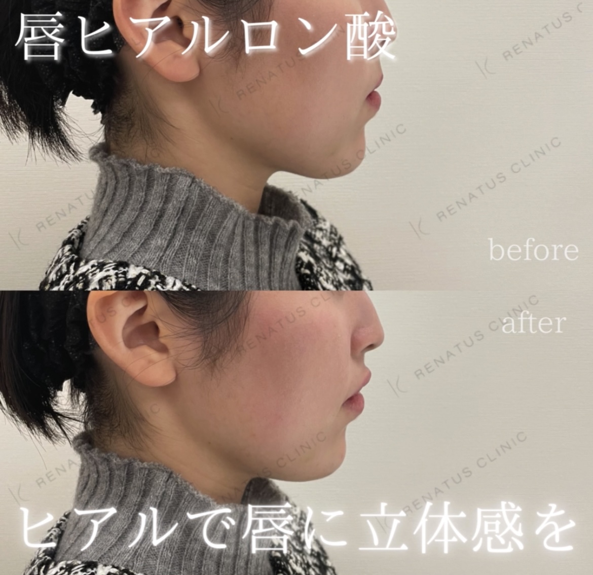 唇ヒアルロン酸ボルベラ症例写真