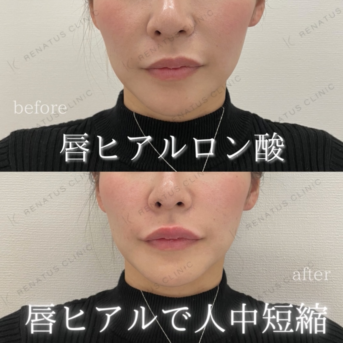 唇ボルベラヒアルロン酸
