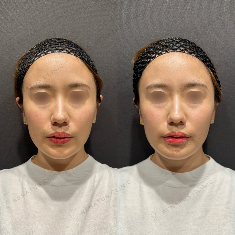 唇ヒアルロン酸ボルベラ症例写真