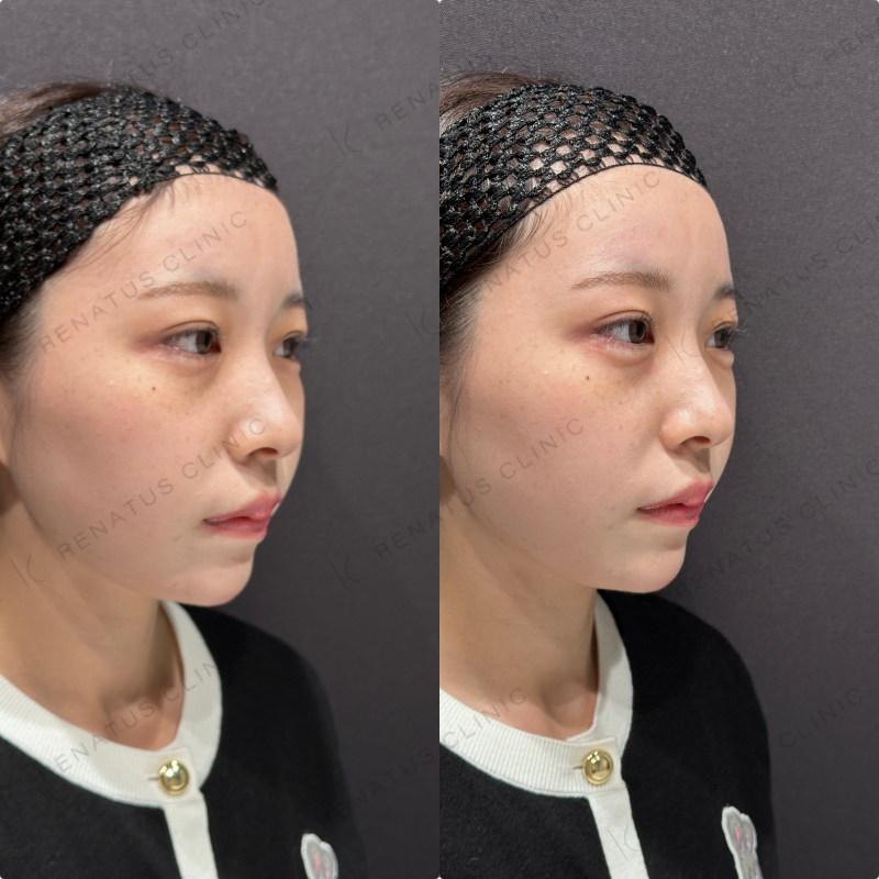 涙袋ヒアルロン酸ボルベラ症例写真
