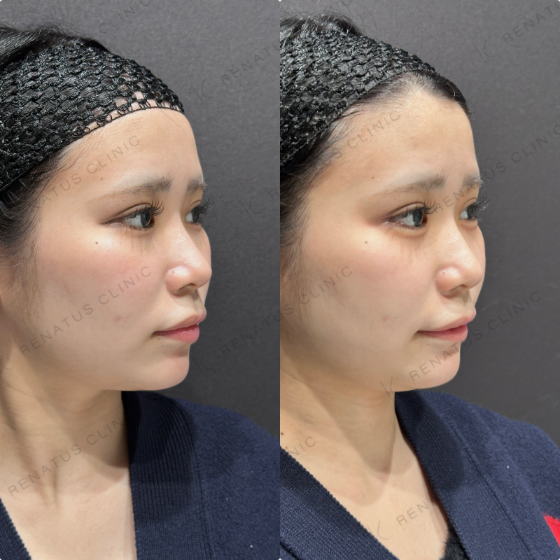 涙袋ヒアルロン酸ボルベラ症例写真