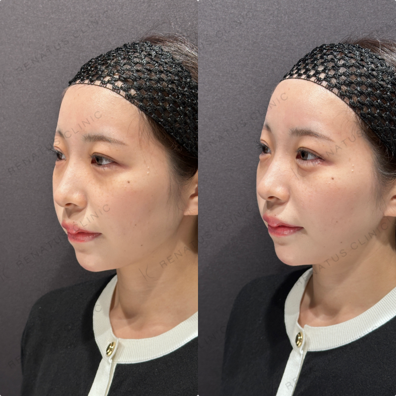 涙袋ヒアルロン酸ボルベラ症例写真