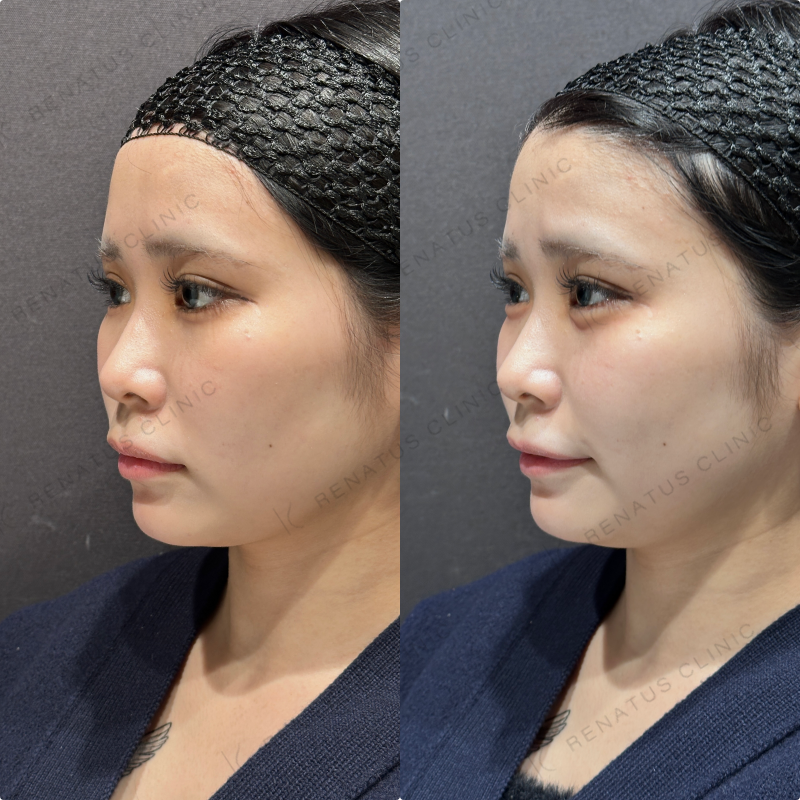 涙袋ヒアルロン酸ボルベラ症例写真