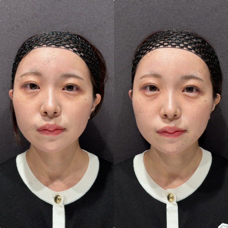 涙袋ヒアルロン酸ボルベラ症例写真